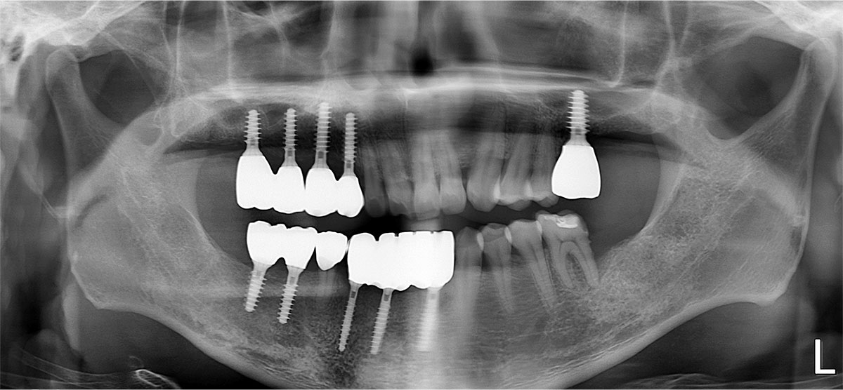 임플란트 식립 상태를 확인하는 파노라마 X-ray