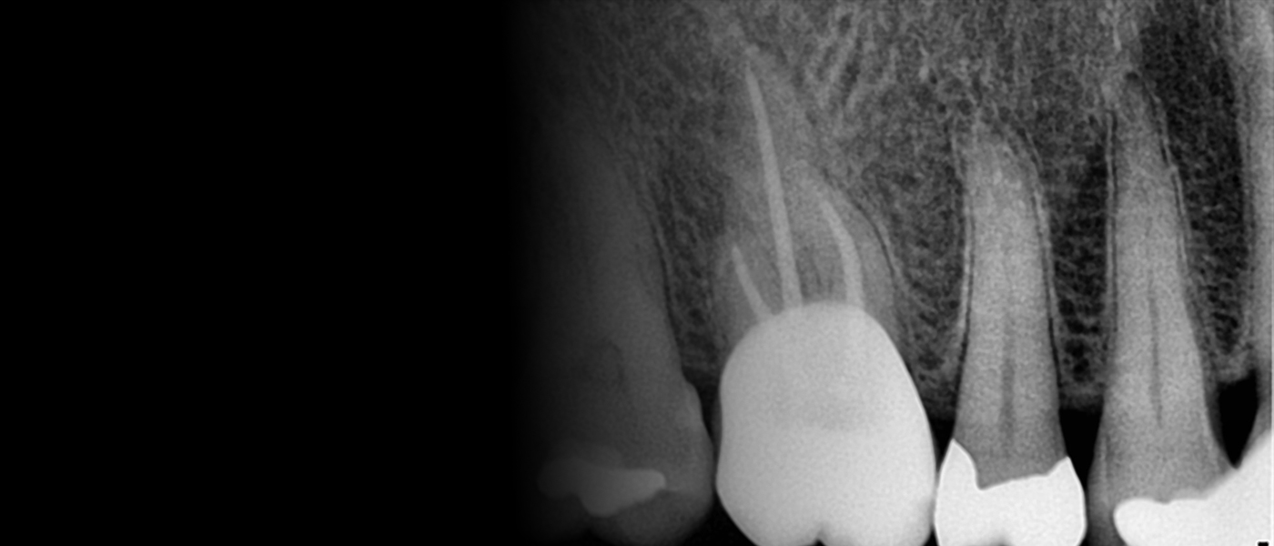 치근단 X-ray — 근관 수와 감염 진행 확인