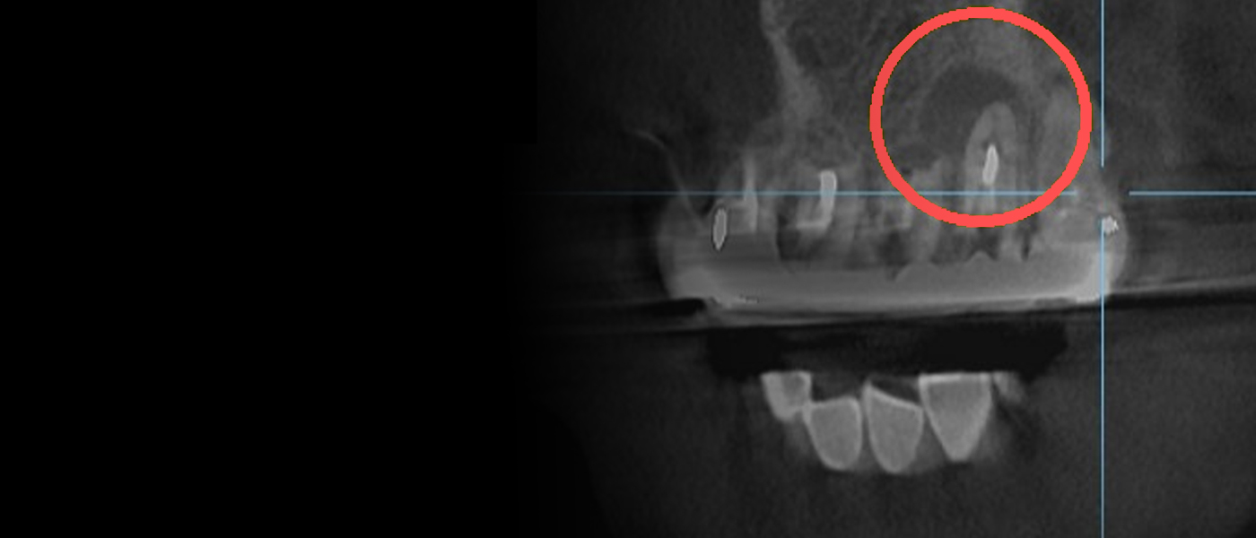 CBCT 영상에서 붉은 원으로 표시한 병소 부위