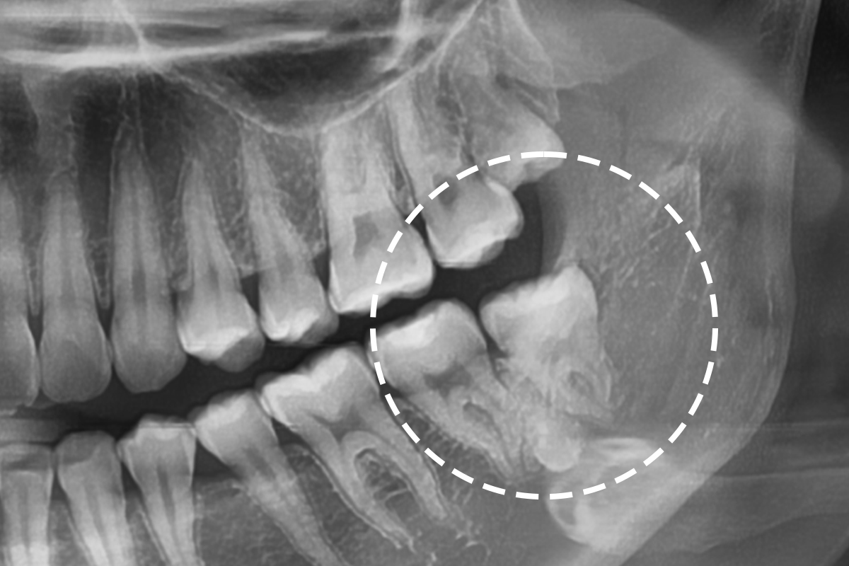 파노라마 X-ray 사진 — 발치 전 치아·뿌리 상태 확인
